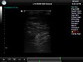 File:Active-Ultrasound-Pattern-Injection-System-(AUSPIS)-for-Interventional-Tool-Guidance-pone.0104262.s001.ogv