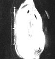 File:Time-Efficient-3D-Radial-UTE-Sampling-with-Fully-Automatic-Delay-Compensation-on-a-Clinical-3T-MR-pone.0150371.s002.ogv