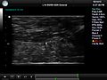 File:Active-Ultrasound-Pattern-Injection-System-(AUSPIS)-for-Interventional-Tool-Guidance-pone.0104262.s002.ogv