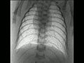 File:Changes-in-Positive-End-Expiratory-Pressure-Alter-the-Distribution-of-Ventilation-within-the-Lung-pone.0093391.s002.ogv