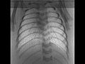 File:Changes-in-Positive-End-Expiratory-Pressure-Alter-the-Distribution-of-Ventilation-within-the-Lung-pone.0093391.s001.ogv