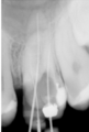 Tooth26RootCanal.png