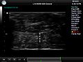 File:Active-Ultrasound-Pattern-Injection-System-(AUSPIS)-for-Interventional-Tool-Guidance-pone.0104262.s008.ogv