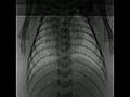 File:Changes-in-Positive-End-Expiratory-Pressure-Alter-the-Distribution-of-Ventilation-within-the-Lung-pone.0093391.s003.ogv