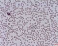 B Thalassaemia Trait (Basophilic Stippling).jpg