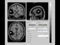 File:Mathematical-Modeling-of-Human-Glioma-Growth-Based-on-Brain-Topological-Structures-Study-of-Two-pone.0039616.s001.ogv