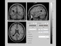 File:Mathematical-Modeling-of-Human-Glioma-Growth-Based-on-Brain-Topological-Structures-Study-of-Two-pone.0039616.s002.ogv